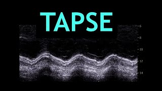 All about TAPSE Echocardiography [upl. by Sinai]