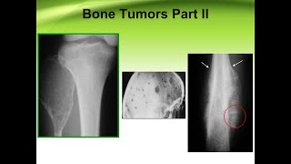 Bone tumors part II [upl. by Anez892]