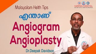 എന്താണ് Angiogram Angioplasty [upl. by Ynnos]