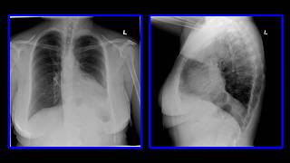 PULMONARY EMBOLI XRAY MedEd PatientExperience [upl. by Zackariah]