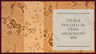 Pyuria Pus cells in urine microscopy at 40 X [upl. by Sewole118]