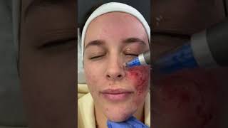 Microneedling with Dermapen 4 at DRMEDISPA [upl. by Lanta]