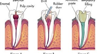 4 Root Canal Alternatives [upl. by Pennington]