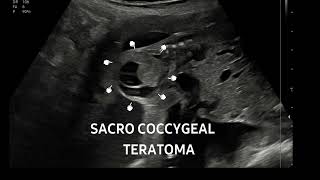 Sacrococcygeal teratoma at 22 weeksFollowup of this case httpsyoutubeYa59lnLs [upl. by Selinda]