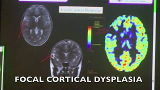 TMT ARTERIAL SPIN LABELING IN NEURORADIOLOGY [upl. by Carri928]