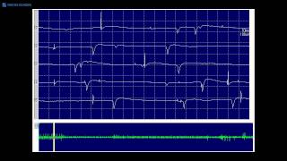 Kimura amp Kohara F17 Fibrillation potentials and positive sharp waves [upl. by Aytnahs468]