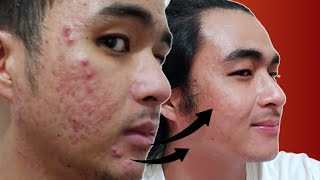 BEST ISOTRETINOIN TIMELAPSE ON YOUTUBE  Acnetrex Journey for 8 Months in 2 Minutes  KevInSeries [upl. by Denyse]