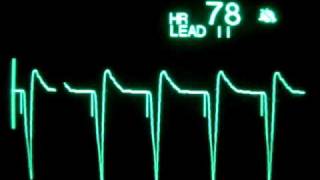 Ventricular Pacing [upl. by Frentz365]