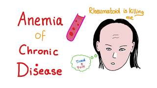 Anemia of Chronic Disease  Anemia of Inflammation All you need to know  Hematology Series [upl. by Egon]