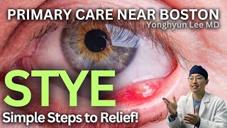 Is Your Eyelid Swelling a Stye How to Identify and Treat It [upl. by Ingham]