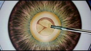 Small Incision Cataract Extraction [upl. by Nybbor176]