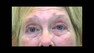 VIMPAT Blepharospasm Hemifacial Spasm Testimonial 2 [upl. by Alby914]