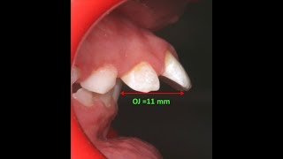 Amazing two phase treatment of Sever Class II Div 1  lama 10Y [upl. by Aneel]