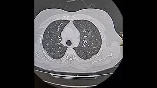 Desquamative interstitial pneumonia Axial scan [upl. by Yffat971]