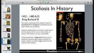 Big History of Scoliosis Treatment [upl. by Survance331]