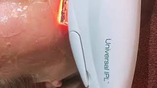 Lumenis m22 for your skin treatmentantiaging [upl. by Euk]