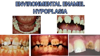 ENVIRONMENTAL ENAMEL HYPOPLASIA  DEVELOPMENT DISTURBANCE IN THE STRUCTURE OF TEETH [upl. by Chastity]