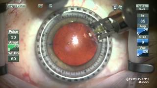 Corneal Relaxing Incisions  NAPA NOMOGRAM [upl. by Dotti968]