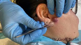 Drainage of an infected cyst in front of the ear [upl. by Krystin873]