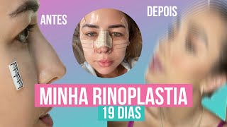 TUDO SOBRE MINHA RINOPLASTIA  PRÉ E PÓS OPERATÓRIO  ANTES E DEPOIS [upl. by Blackburn751]