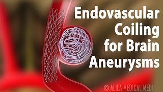 Endovascular Coiling for Brain Aneurysm Animation [upl. by Namzed]