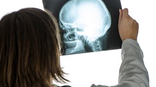 Le traumatisme craniocérébral une blessure sournoise [upl. by Boyse]