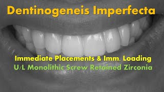 Dentinogenesis Imperfecta Full Arch Immediate Placements amp Loading [upl. by Inotna]