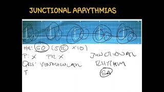 ECGJunctional Arrythmias [upl. by Xad129]