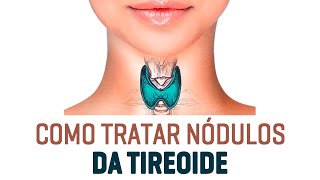 NÓDULO NA TIREOIDE É PERIGOSO [upl. by Eiroc]