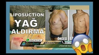 Liposuction Yağ Aldırma  Ameliyat Olmadan İzle [upl. by Tanah]