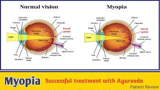 Ayurvedic eye treatments to improve Decreasing Vision naturally  Dr Bharat Bhushan  Myopia [upl. by Ahtael]