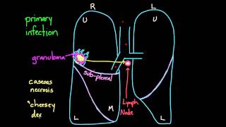 Primary and Secondary TB [upl. by Avron911]