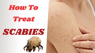 How To Treat Scabies Effectively  From PERMETHRIN Cream To IVERMECTIN Tablets [upl. by Odnaloy]