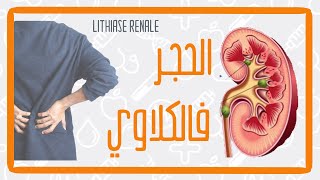 تدويزة  الحجر فالكلاوي TEDWIZA Calculs rénaux lithiase rénale [upl. by Chin634]