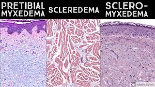 Pretibial Myxedema vs Scleredema vs Scleromyxedema  Dermatopathology quotSoundAlikesquot [upl. by Enael653]