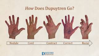 Dupuytren Awareness [upl. by Betteanne539]