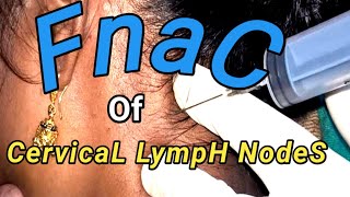 Fnac of Cervical Lymph Nodes ।। [upl. by Xxam]