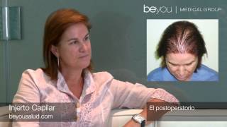 Resultados de Injerto Capilar en Mujeres Transplante de Pelo en mujer Beyou Medical Group HD [upl. by Otha]