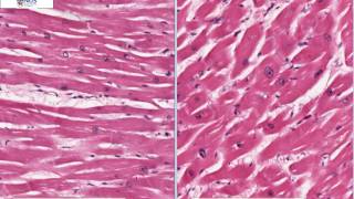 Left ventricular hypertrophy Talking Slide [upl. by Alet]