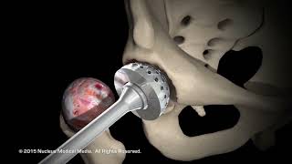 Dr Patterson  Lateral Approach Total Hip Replacement [upl. by Kienan905]