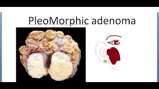 Pathology 533 a Pleomorphic Adenoma Mixed Salivary Tumor Gland Parotid Benign Lacrimal [upl. by Brigette705]