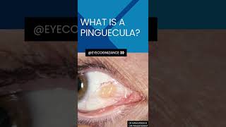 what is a pinguecula ¦eyecognizance [upl. by Galatea]