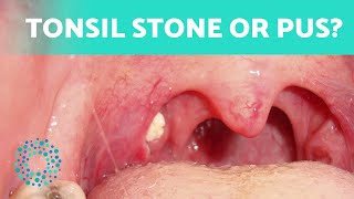 The Difference Between TONSIL STONES and TONSILITIS 👄 How to Tell Them Apart [upl. by Brigitta]