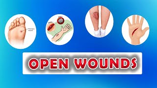 Types of Open Wounds Abrasion Laceration Skin Avulsion Puntured wounds [upl. by Leunammi]