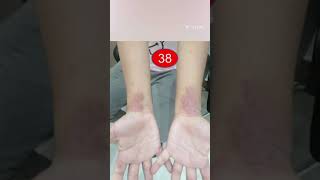 InteractiveDermatology clinic Cases 37 Koilonychia amp 38 Atopic dermatitis [upl. by Lodovico]