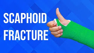 Scaphoid Fractures [upl. by Okiek]