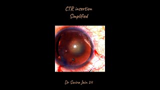 The Technique of Inserting the Capsule Tension Ring CTR [upl. by Secilu100]