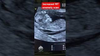 Increased NT anomaly scan sonography pregnancy screening ARDMS [upl. by Purdum]