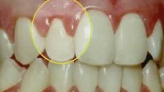 Periodontal Disease amp Treatment [upl. by Adnawot]