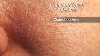 How to Treat Different Types of Acne [upl. by Sedgewinn]